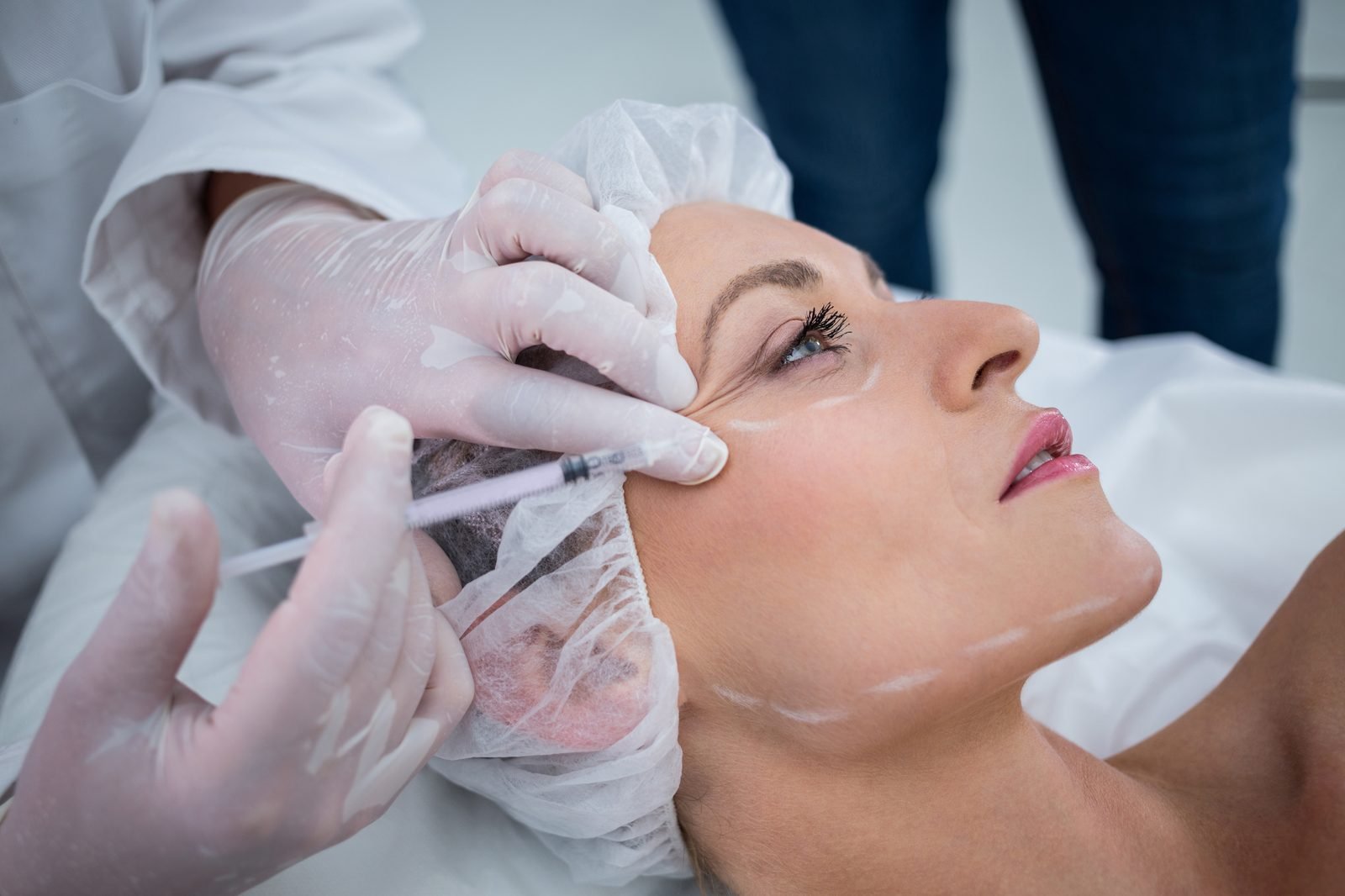 Mesotherapy procedure